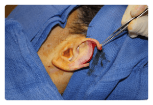 Macrotia repair surgery photo